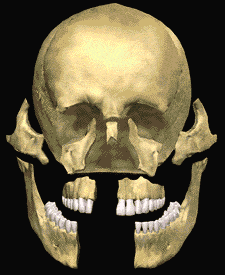 Animated 3D of facial trauma
