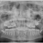 X-ray showing impacted canines