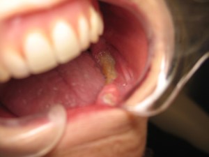 Osteonecrotic area in a persons' mouth