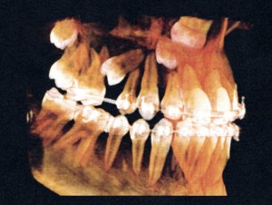 CT scan showing impacted teeth