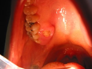 Osteonecrotic area in a persons' mouth