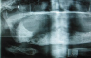X-ray of a fractured mandible caused by osteonecrosis