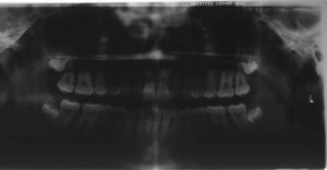 Poor quality x-ray
