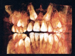 CT scan showing impacted canines